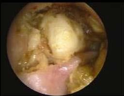 Cholesteatoma Looks like an onion Produces osteolytic enzymes Complications