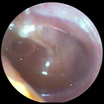 Otitis Media with Effusion Effusion-seeping of watery fluid from tissue OME is thick or watery fluid in