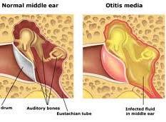 Considerations of Otitis Media and Hearing Aid Fitting No active infection Conductive hearing loss and