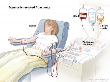 How are stem cells donated Stimulated Peripheral Blood Stem Cell Donation Blood is drawn through a needle.