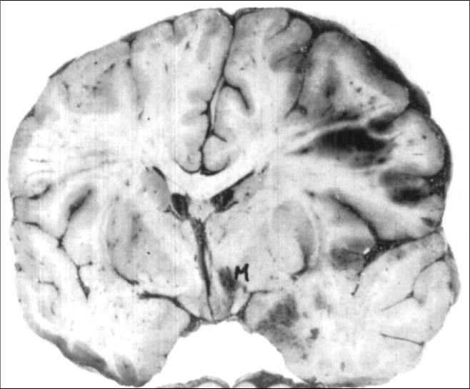 R, Brain 1971;94:165-72
