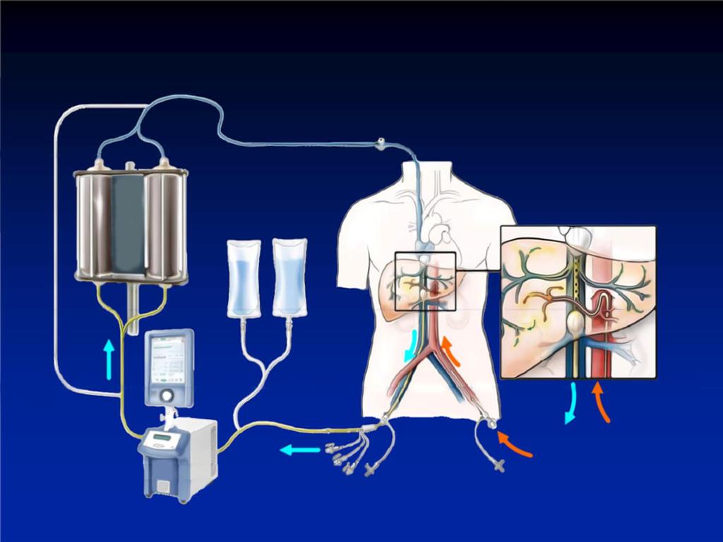 PERCUTANEOUS HEPATIC PERFUSION ( PHP ) Chemofiltration