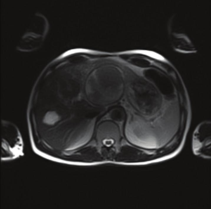 2 Case Reports in Hepatology Figure 1: Magnetic resonance imaging sections.
