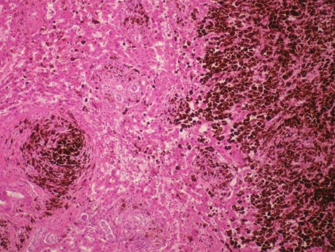 3%), brain (54.6%), bone (48.6%), and adrenal glands (46.8%) are the other solid organs that malignant melanoma metastases [5].