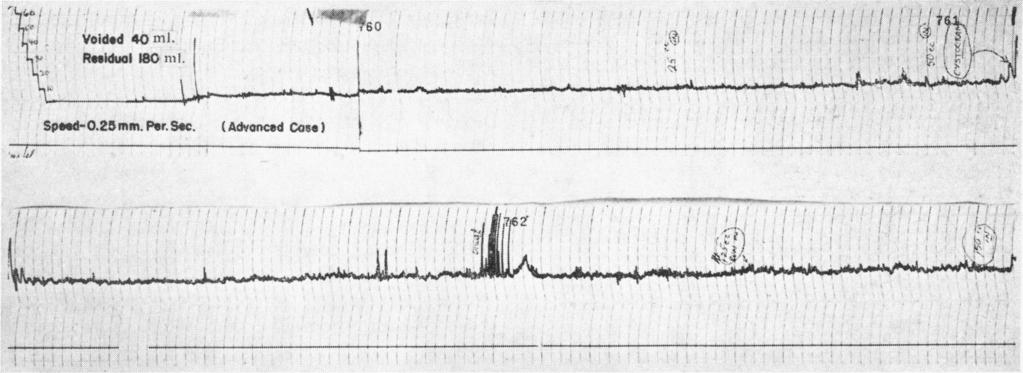 FIG. 3.-Normal cystometrogram demonstrating normal contractions at 20 cm.