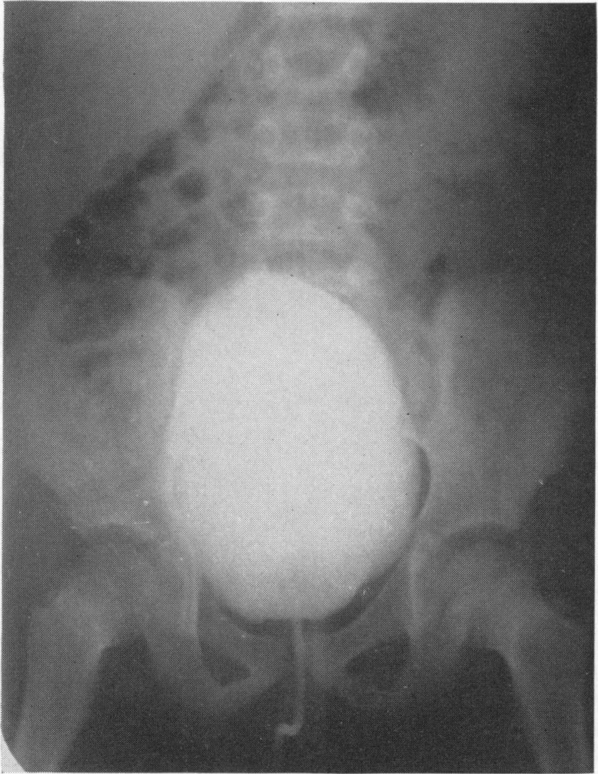 The ureterovesical junction ultimately becomes incompetent and vesico-ureteral reflux occurs, favouring the spread of infection and contributing to dilatation of the ureters.