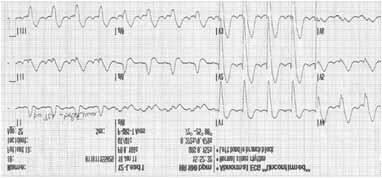 Slika 3. Pojav LKB ob bolečini. Slika 4. EKG v stabilnem stanju, brez bolečin.