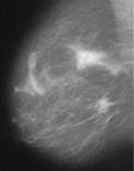 Mammography - the ultimate challenge with
