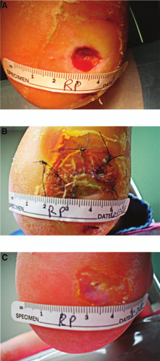 Figure 4. Photographs of the left heel before (A) and 10 days (B) and 8 weeks (C) after equine pericardium biomatrix application. weeks and 24.