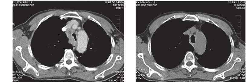 SHEN et al: STEREOTACTIC ABLATIVE RADIOTHERAPY FOR LUNG TUMORS 1295 A B Figure 2. A 70 year old male patient with squamous carcinoma. (A) Tumor in the main trachea prior to SBRT (2011 03 08).
