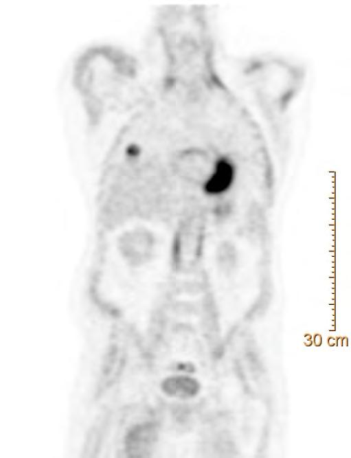 bisulfate) 4 cm right upper lobe lung mass PET
