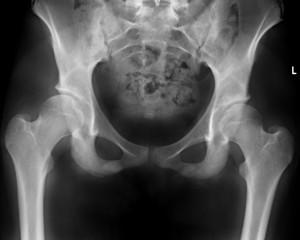 The condition can affect the thighbone, however the most common complications in hip dysplasia are those to the socket. Abnormally shallow sockets characterize Dysplastic hips.
