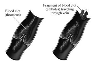 Causes: MI or A-fib, atherosclerosis Other causes: blunt trauma compartment syndrome Thrombus
