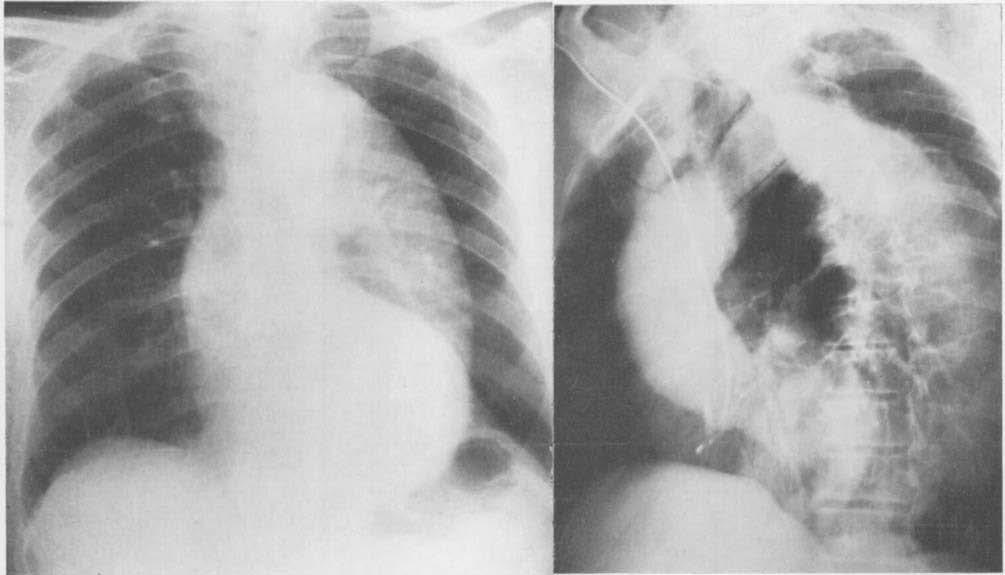 Bypass for Pericardiectomy and Aneurysms A FIG. 1. X-ray of chest (A) and aortogram (B) in 74-year-old man with massive artel-iosclerotic aneurysm of descending thoracic aorta.