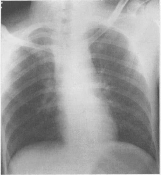 Bypass for Pericardiectomy and Aneurysms FIG. 3. X-ray of chest demonstrating widened superior mediastinum in 24-yearold man after auto-pedestrian accident.