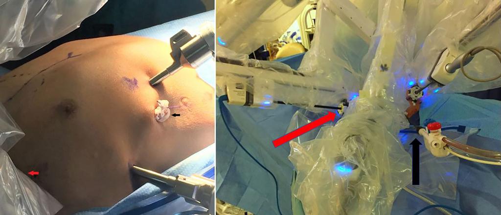 Journal of Visualized Surgery, 2018 Page 3 of 6 A B Figure 2 Port placement for the right-sided lateral approach. (A) With robot undocked; (B) with three robotic arms docked and one assistant port.