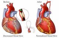 coronary artery bypass graft (CABG) CABG is a surgery to restore blood flow to the heart muscle.