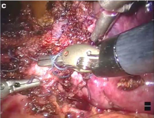 robotic left lateral sectionectomy J