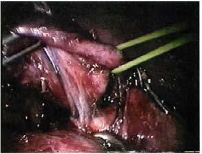 cystectomy and biliary