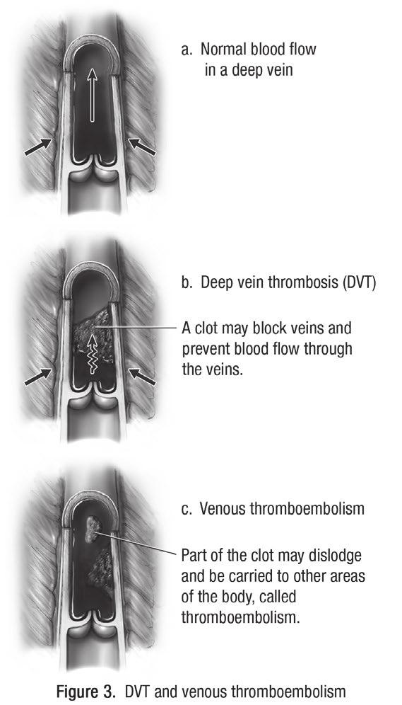 Page 3 of 12 About Deep Vein Thrombosis Venous thrombosis happens when a blood clot forms in one of more veins.
