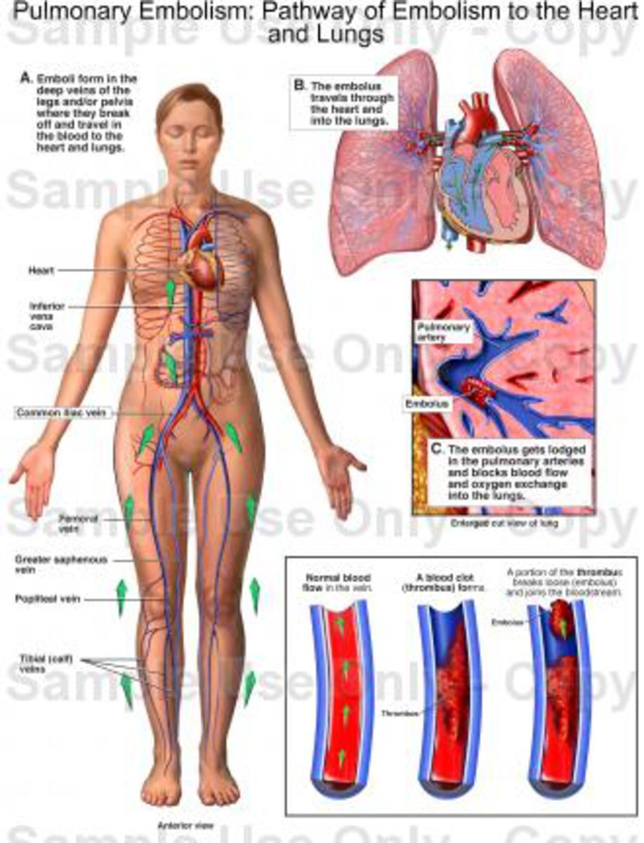 Fig. 2: Pulmonary Embolism: Pathway of