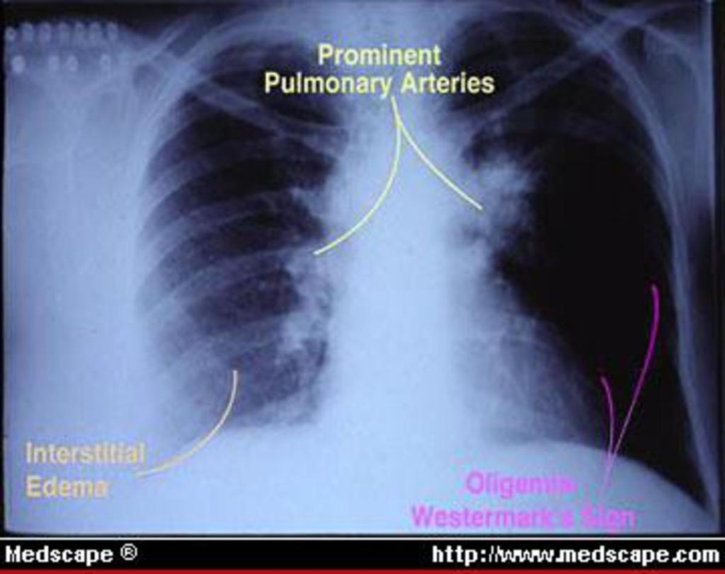 Fig. 3: Chest X-ray in
