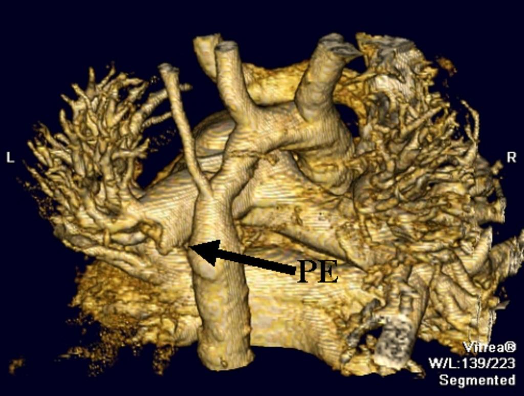 Fig. 5: Computed tomographic (CT) pulmonary angiography of acute pulmonary embolism (PE).