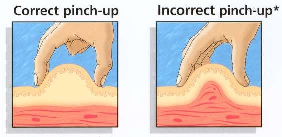 Correct Pinch-up Correct Pinch-up It should be done only with the thumb and index/middle finger.