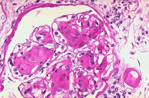 Renal complications Renal glomerulus with nodular glomerulosclerosis