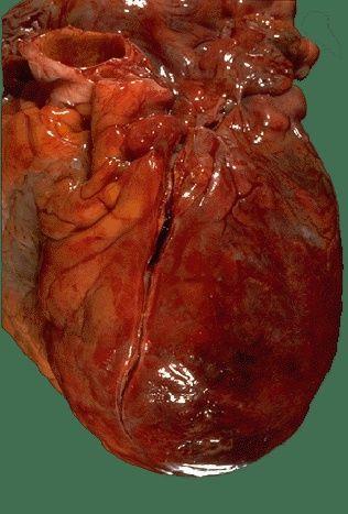Atherosclerosis Left anterior descending coronary