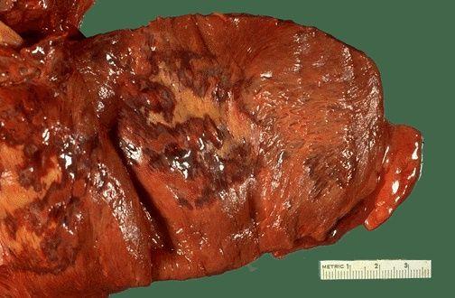 Atherosclerosis The interventricular septum has been sectioned to reveal a large recent myocardial