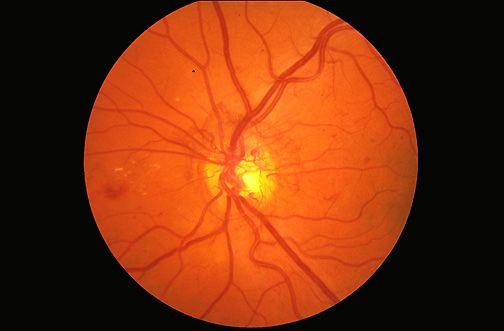 RETINOPATHY Proliferative diabetic retinopathy on funduscopic examination is shown