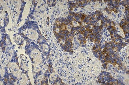 Insulinoma This is an immunohistochemical stain for