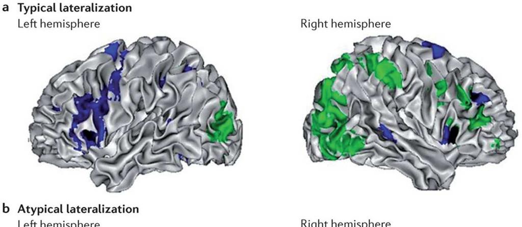 Strong bias for language lateralization to the left hemisphere Regions
