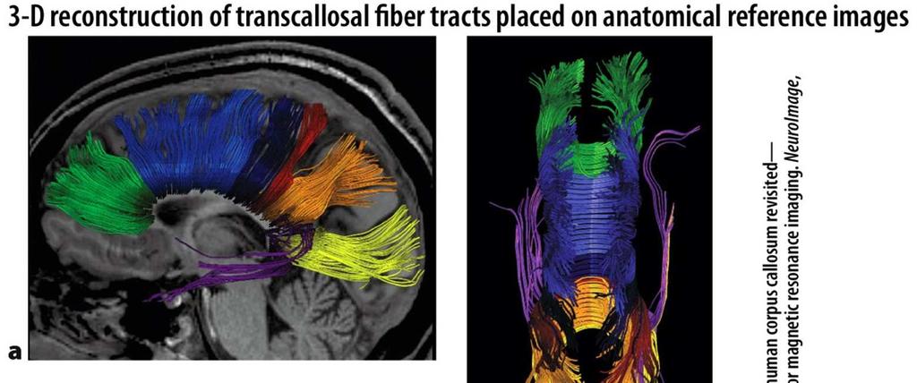 Callosal fiber bundles projecting into the prefrontal lobe (coded in
