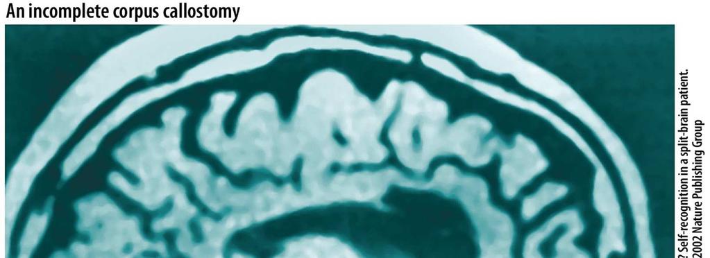 MRI scan showing that the splenium (arrow) was