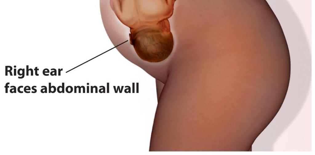 Most fetuses are oriented with the right ear facing outward, resulting in different vestibular signals