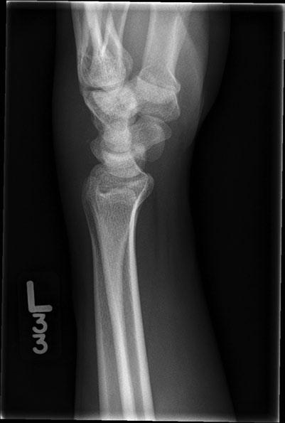 Chapter 1 Figure 1.7 Triquetral fracture: Anteroposterior radiograph of a subtle triquetral fracture. (Image courtesy of Timothy Sweeney, MD.