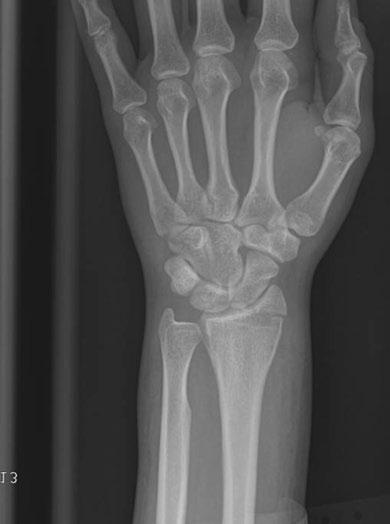 Hand and wrist emergencies Figure 1.5 Hutchinson fracture: An intra-articular fracture through the radial styloid process. (Image courtesy of Carl Germann, MD.