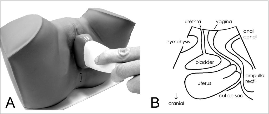 The use of translabial ultrasound in women with pelvic floor disorders Figure 1: Standard transducer placement for translabial ultrasound (A) and image orientation in the midsagittal plane (B).