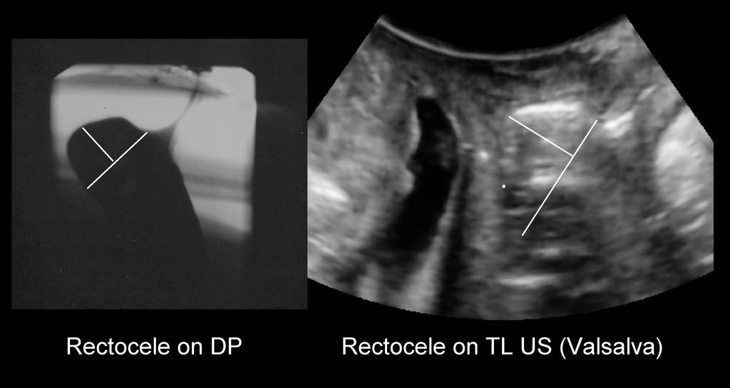 The Posterior Compartment Pelvic floor ultrasound is particularly useful in the posterior compartment, and we have in no way realised its potential benefits for clinical practice.