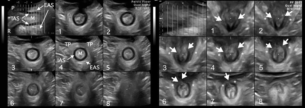 Figure 5: Determination of slice location and thickness for EAS assessment by translabial tomographic ultrasound.