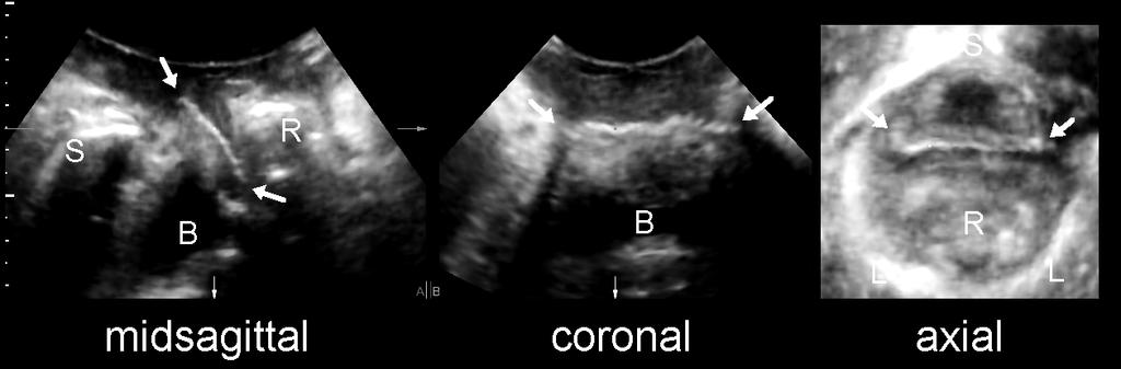 Fig. 8: A transobturator mesh, as seen in the midsagittal (left), coronal (middle) and axial plane (right).