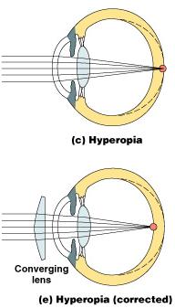 Accommodation Problems Hyperopia: Farsighted The eyeball is too shallow or the curvature of the lens is too