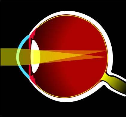 Astigmatism The degree of curvature in the cornea or lens varies from one axis to another (is