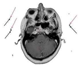02) Benchmark Test of Cranial CT/MR Registration IJROBP Kenneth et al.