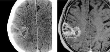 Modality Modality affects GTV & CTV contouring: Tumor volumes across sites are typically larger on CT+MRI CT only CT + MRI A difference of 10 cm 3! Modality Mean Volume CT only 59.5 cm 3 CT + MRI 69.