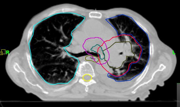 Figure 6 Axial slice of kvct study made 39 days after treatment start date. This study, with the 3D margin around GVT of 1.