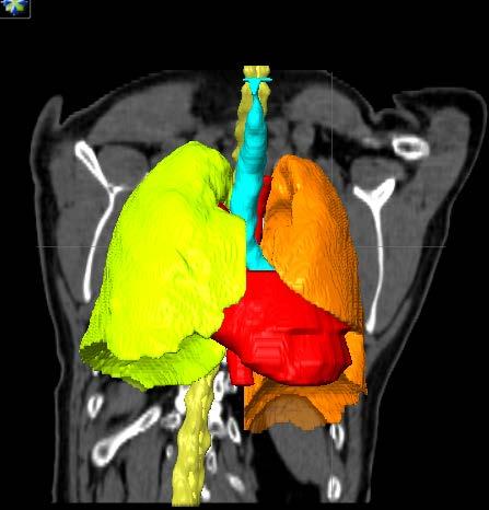 SBRT OARs Rt + Lt lung (pulmonary window) Heart, Trachea, Carina Esophagus_irrad.