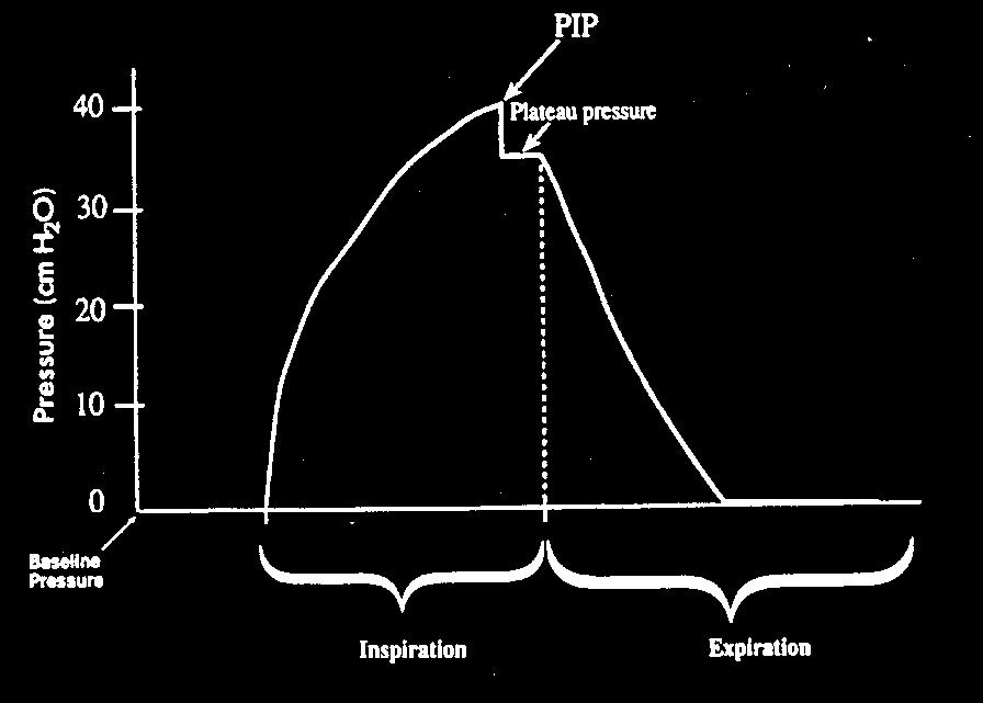 end-inspiration IPP is best indicator of alveolar distension PIP IPP